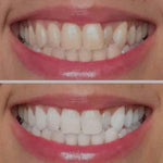 1-Ultra Violet Teeth Whitening Gel